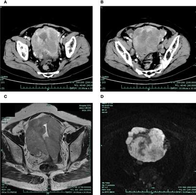 Complete Response to Immunotherapy Combined With Chemotherapy in a Patient With Gynecological Mixed Cancer Mainly Composed of Small Cell Neuroendocrine Carcinoma With High Tumor Mutational Burden: A Case Report